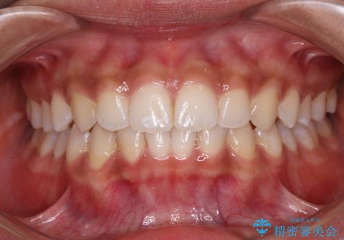 前歯のデコボコを治したい インビザライン・モデレートによる矯正治療の症例 治療後