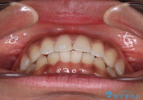 前歯のデコボコを治したい インビザライン・モデレートによる矯正治療の治療後