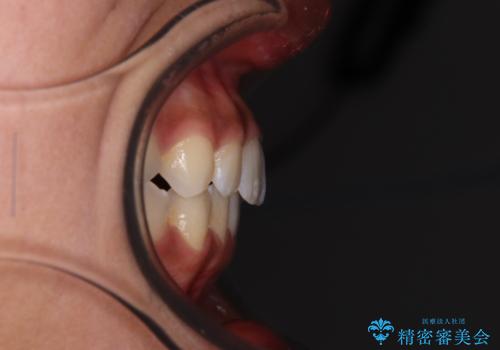 前歯のデコボコを治したい インビザライン・モデレートによる矯正治療の治療後