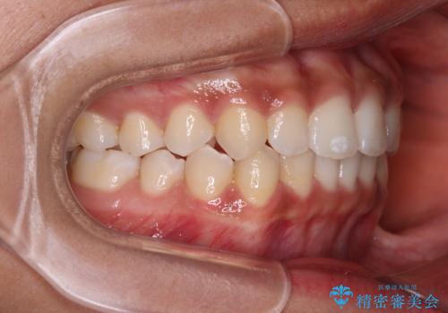 前歯のデコボコを治したい インビザライン・モデレートによる矯正治療の治療後