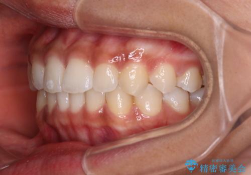 前歯のデコボコを治したい インビザライン・モデレートによる矯正治療の治療後