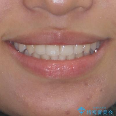前歯のデコボコを治したい インビザライン・モデレートによる矯正治療の治療後(顔貌)
