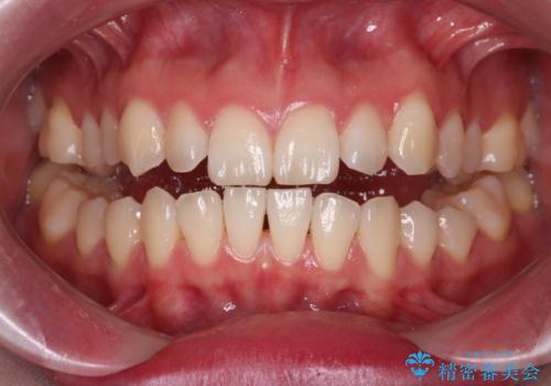 【ワイヤー矯正】一番後ろの奥歯でしか噛んでいないかみ合わせを治したいの症例 治療前