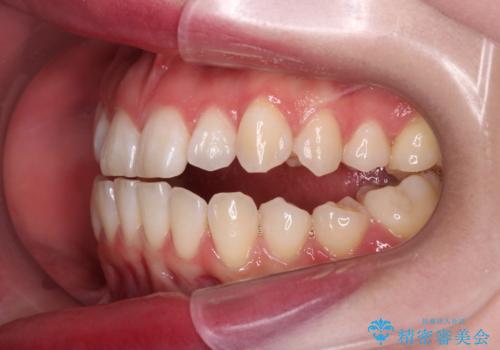 【ワイヤー矯正】一番後ろの奥歯でしか噛んでいないかみ合わせを治したいの治療前