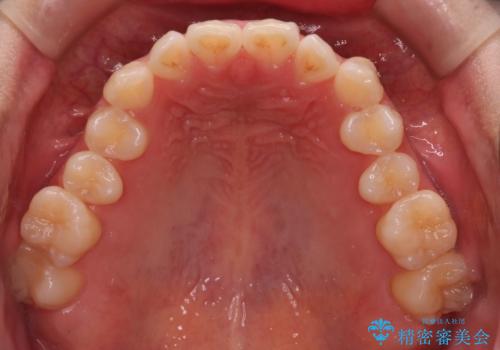 【ワイヤー矯正】一番後ろの奥歯でしか噛んでいないかみ合わせを治したいの治療前