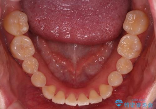 【ワイヤー矯正】一番後ろの奥歯でしか噛んでいないかみ合わせを治したいの治療前