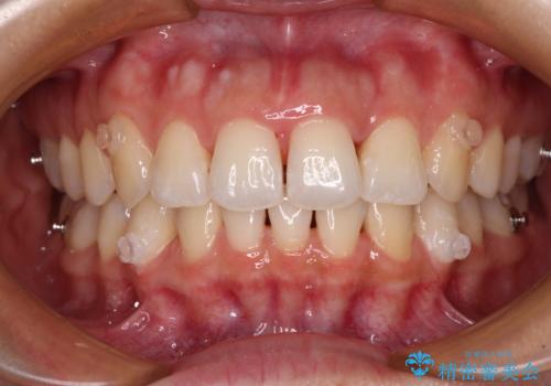 捻れた前歯をインビザラインで整えるの治療中