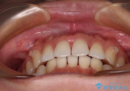 捻れた前歯をインビザラインで整えるの治療中