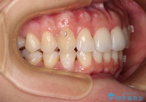 捻れた前歯をインビザラインで整えるの治療中