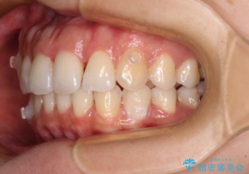 捻れた前歯をインビザラインで整えるの治療中