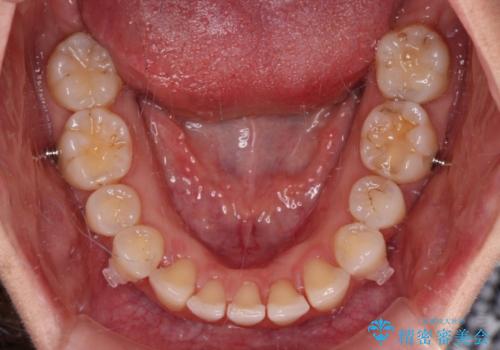 捻れた前歯をインビザラインで整えるの治療中