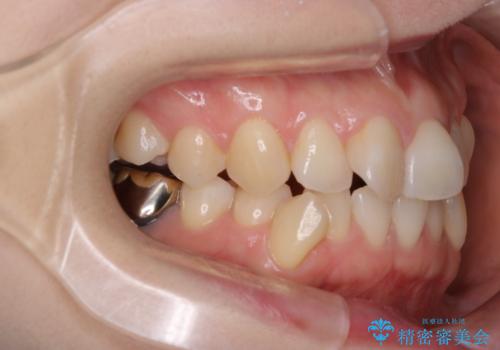 【ワイヤー矯正】がたつきを治したいの治療前