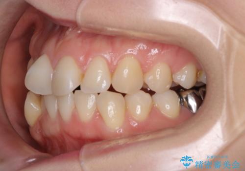 【ワイヤー矯正】がたつきを治したいの治療前