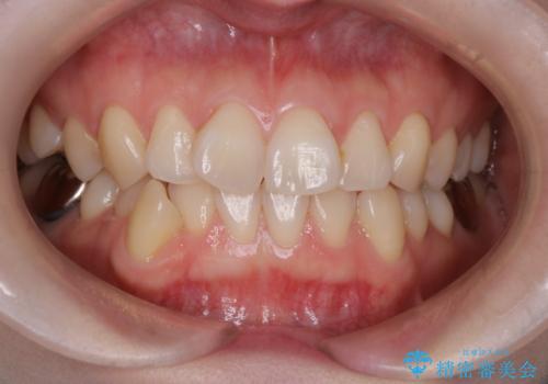 【ワイヤー矯正】がたつきを治したいの治療前