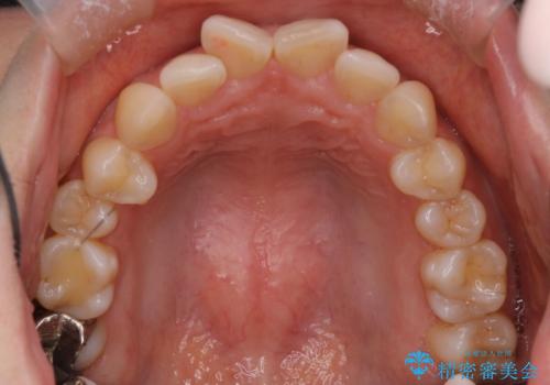 【ワイヤー矯正】がたつきを治したいの治療前