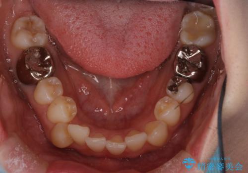 【ワイヤー矯正】がたつきを治したいの治療前