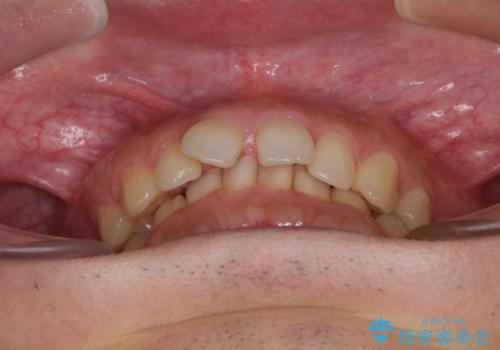 【モニター】前歯に隙間ができるほどのディープバイト ワイヤー装置で負担の少ない咬み合わせにの治療前