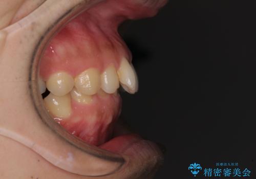 【モニター】前歯に隙間ができるほどのディープバイト　ワイヤー装置で負担の少ない咬み合わせにの治療前