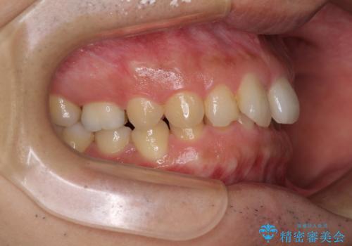 【モニター】前歯に隙間ができるほどのディープバイト ワイヤー装置で負担の少ない咬み合わせにの治療前