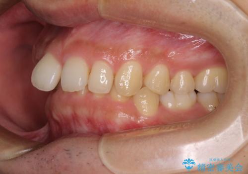 【モニター】前歯に隙間ができるほどのディープバイト ワイヤー装置で負担の少ない咬み合わせにの治療前