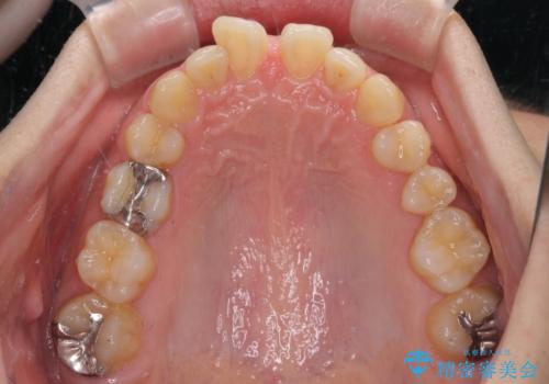 【モニター】前歯に隙間ができるほどのディープバイト ワイヤー装置で負担の少ない咬み合わせにの治療前