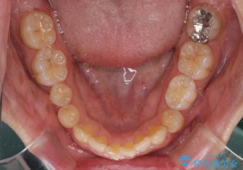 【モニター】前歯に隙間ができるほどのディープバイト　ワイヤー装置で負担の少ない咬み合わせにの治療前
