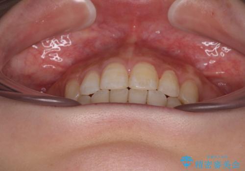 前に出ている上顎 抜歯矯正で唇を閉じやすくの治療後