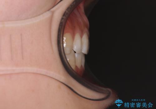 前に出ている上顎 抜歯矯正で唇を閉じやすくの治療後