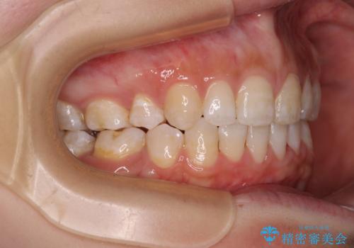 前に出ている上顎 抜歯矯正で唇を閉じやすくの治療後