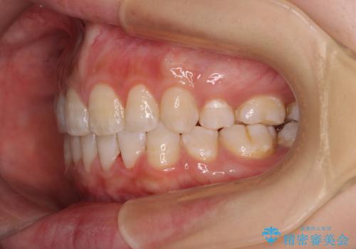 前に出ている上顎 抜歯矯正で唇を閉じやすくの治療後