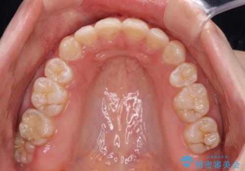 前に出ている上顎 抜歯矯正で唇を閉じやすくの治療後