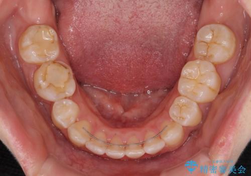 前に出ている上顎 抜歯矯正で唇を閉じやすくの治療後