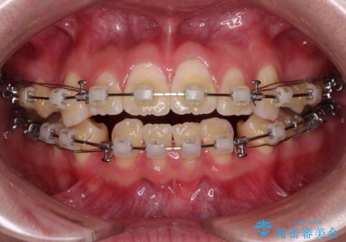 前歯が2本ない　ワイヤー装置での抜歯矯正の治療中