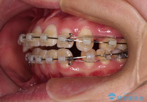 前歯が2本ない　ワイヤー装置での抜歯矯正の治療中