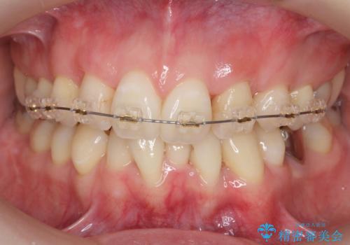 他院で3年以上かかると言われた八重歯を半年できれいに の治療中