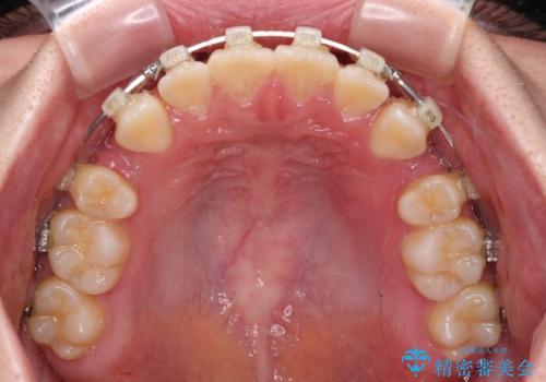 前歯が2本ない ワイヤー装置での抜歯矯正の治療中