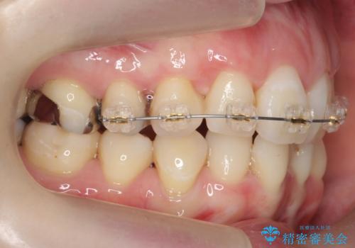 他院で3年以上かかると言われた八重歯を半年できれいに の治療中