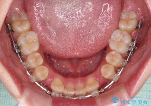 前歯が2本ない ワイヤー装置での抜歯矯正の治療中
