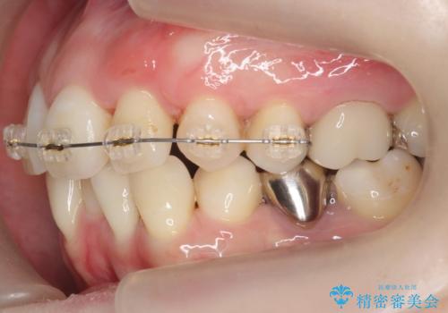 他院で3年以上かかると言われた八重歯を半年できれいに の治療中