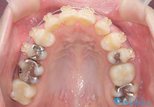 他院で3年以上かかると言われた八重歯を半年できれいに の治療中