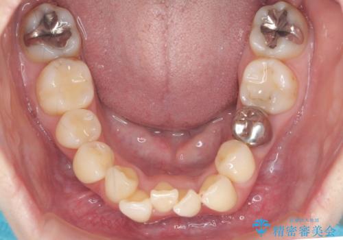 他院で3年以上かかると言われた八重歯を半年できれいに　の治療中