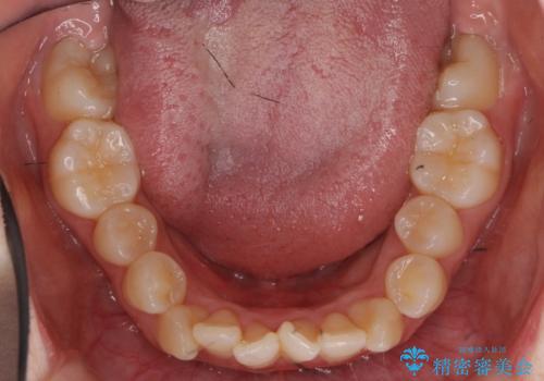 難症例　奥歯がかみ合っていない　歯並び矯正で別人にの治療前