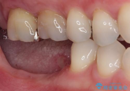 不正咬合で抜歯となった奥歯 インプラントによる咬合回復の治療中