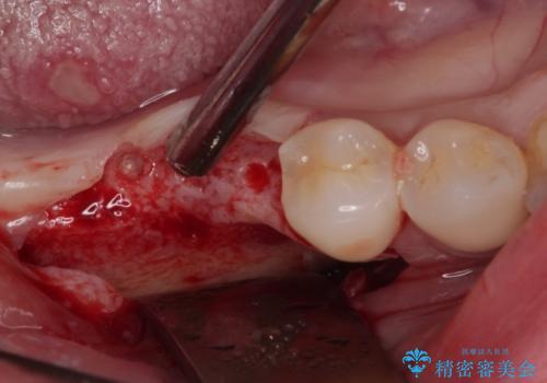 不正咬合で抜歯となった奥歯　インプラントによる咬合回復の治療中
