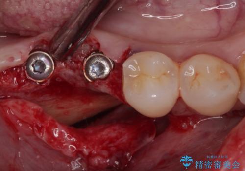不正咬合で抜歯となった奥歯 インプラントによる咬合回復の治療後