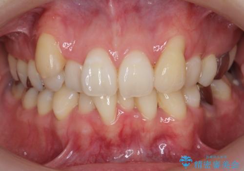他院で3年以上かかると言われた八重歯を半年できれいに の症例 治療前