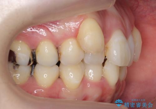 他院で3年以上かかると言われた八重歯を半年できれいに の治療前
