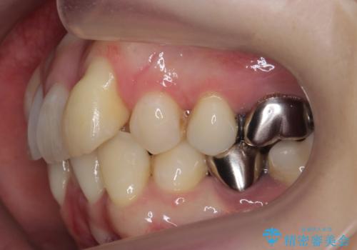 他院で3年以上かかると言われた八重歯を半年できれいに の治療前