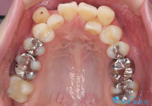 他院で3年以上かかると言われた八重歯を半年できれいに の治療前