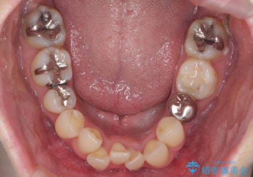 他院で3年以上かかると言われた八重歯を半年できれいに　の治療前